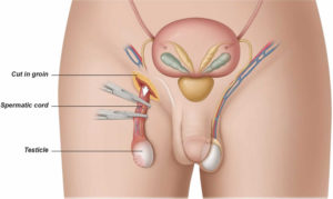 orchiectomy